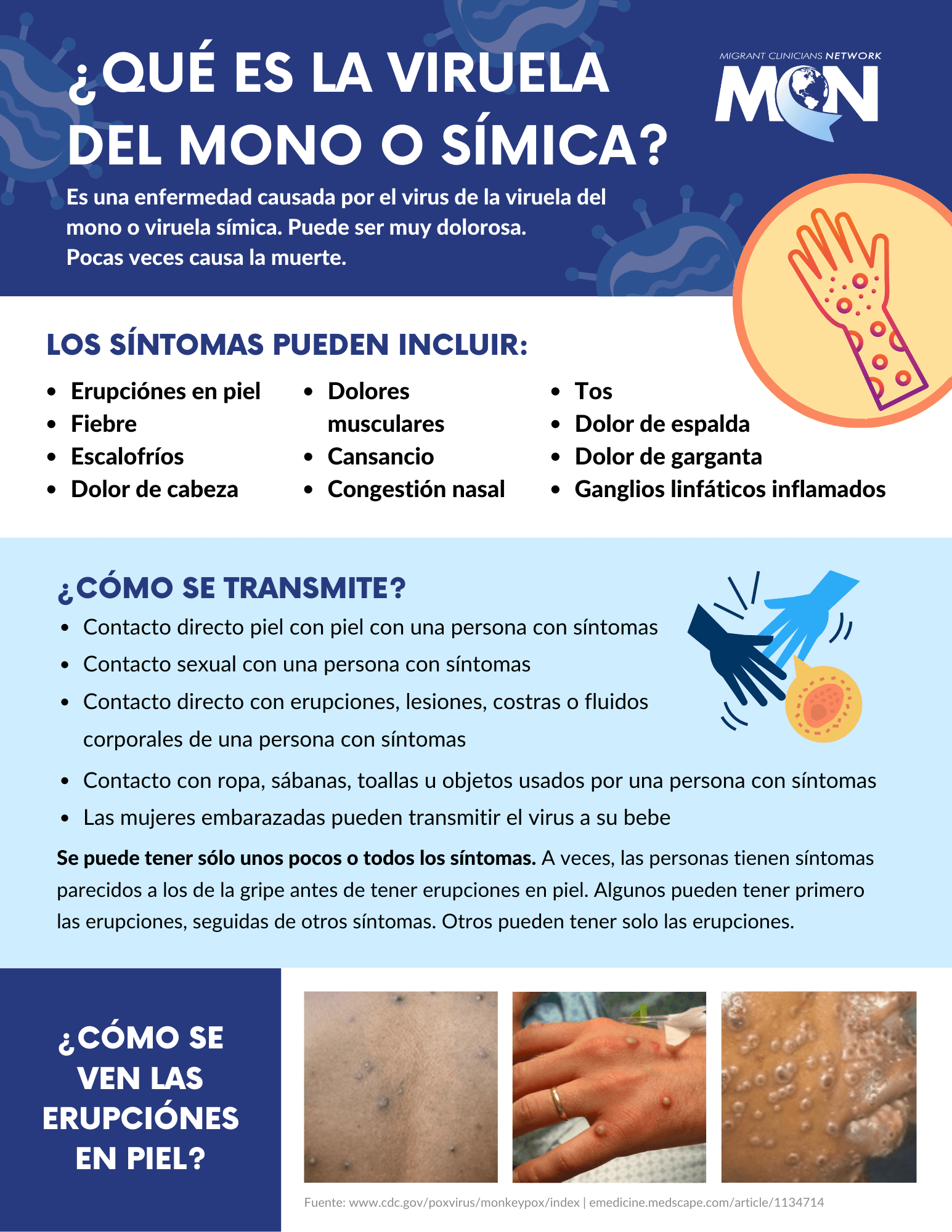 Factsheet with dark blue, light blue, and white background and Migrant Clinicians Network logo at top right corner. Information is in Spanish and is divided into four horizontal sections with the following topics: What is monkeypox?; Symptoms; how it spreads; what does monkeypox look like? Images of monkeypox rash and bumps on back, hand, and face are along the bottom.