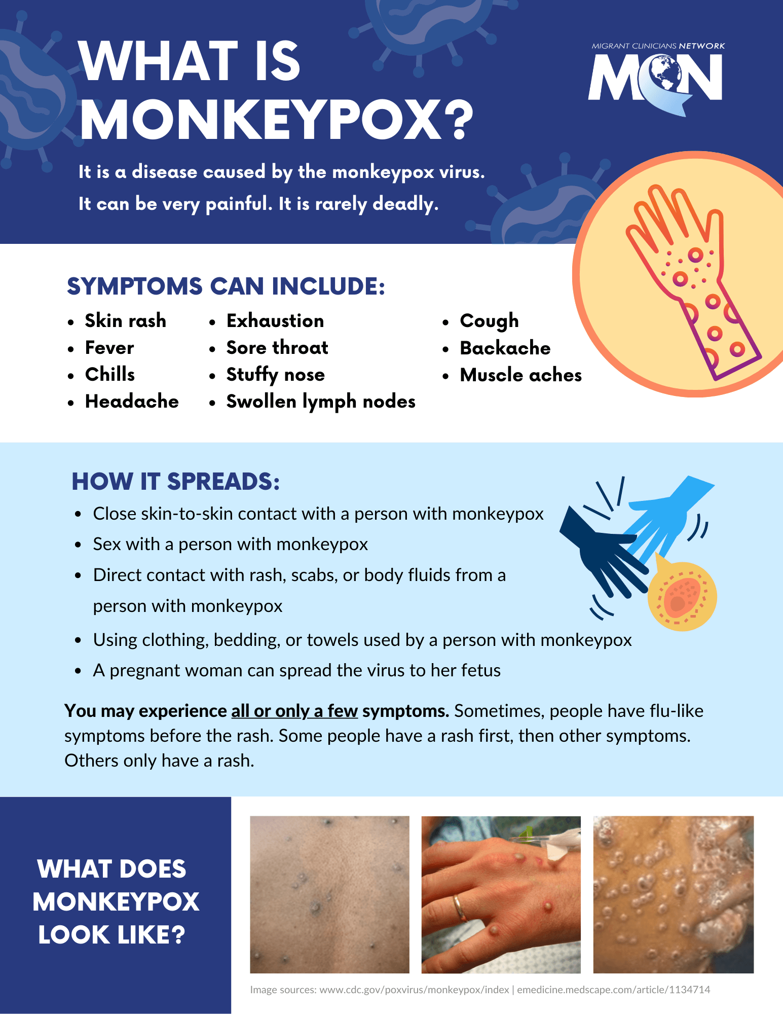 Factsheet with dark blue, light blue, and white background and Migrant Clinicians Network logo at top right corner. Information is divided into four horizontal sections with the following topics: What is monkeypox?; Symptoms; how it spreads; what does monkeypox look like? Images of monkeypox rash and bumps on back, hand, and face are along the bottom.