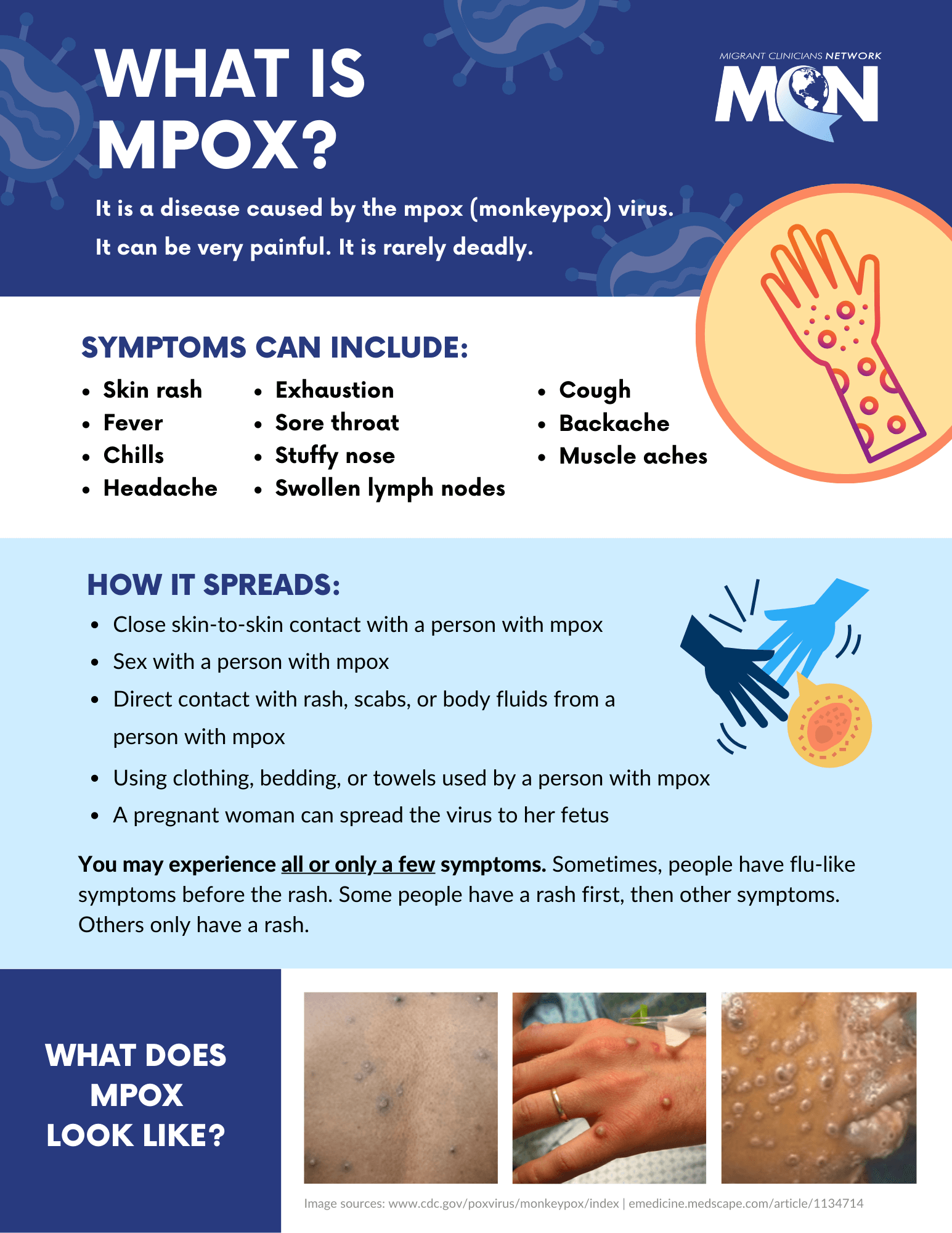 Factsheet with dark blue, light blue, and white background and Migrant Clinicians Network logo at top right corner. Information is divided into four horizontal sections with the following topics: What is monkeypox?; Symptoms; how it spreads; what does monkeypox look like? Photos of monkeypox rash and bumps on back, hand, and face are along the bottom.