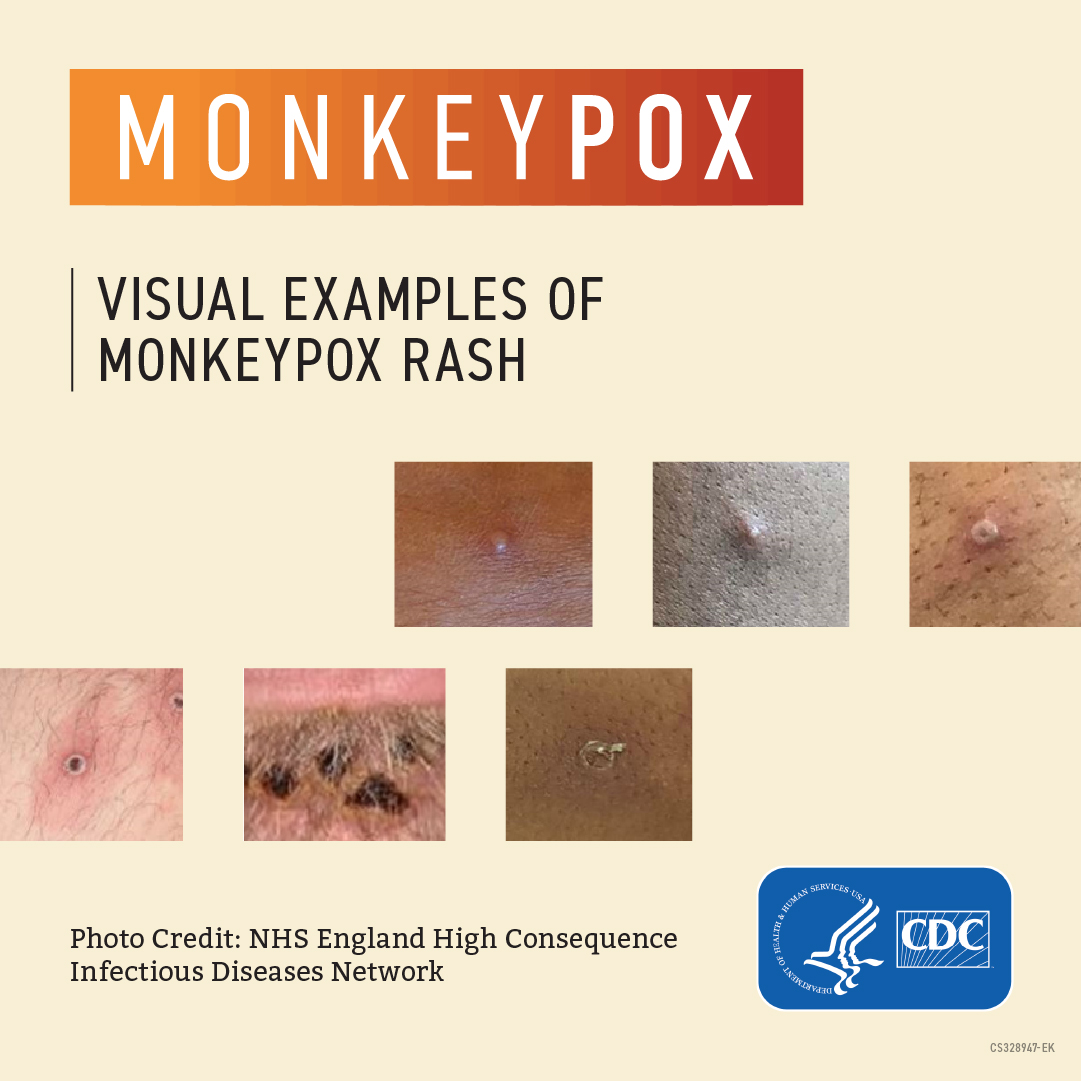 Six close-up images of a monkeypox rash. Text reads, "Monkeypox: Visual examples of monkeypox rash."