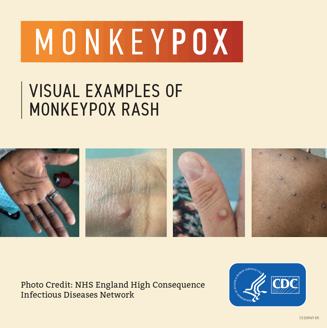 Images of a monkeypox rash on a person's hand, wrist, thumb, and back. Text reads, "Monkeypox: Visual examples of monkeypox rash."